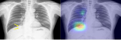 발열과 기침으로 응급실을 방문한 환자의 흉부 X선 영상(사진 왼쪽) 모습. 응급의학과 당직의사는 오른쪽 아래부분 폐의 폐렴 병변(화살표)을 인지하지 못했지만, 인공지능 시스템은 병변의 존재와 위치를 정확하게 식별했다. / 서울대병원